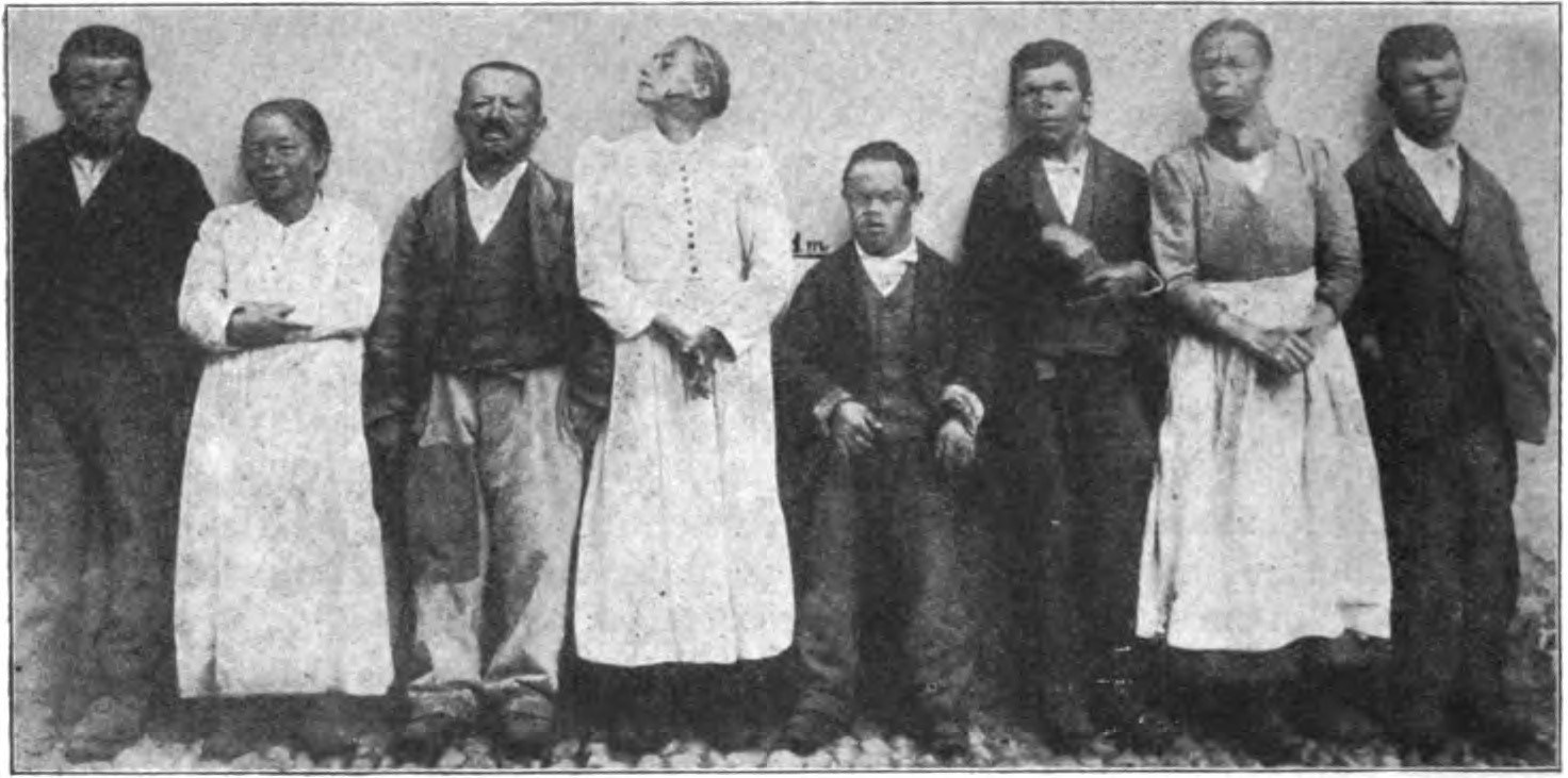 A historical medical photograph documenting endemic goiter.